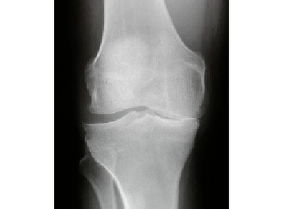 Diagnosi dell'artrosi dell'articolazione del ginocchio