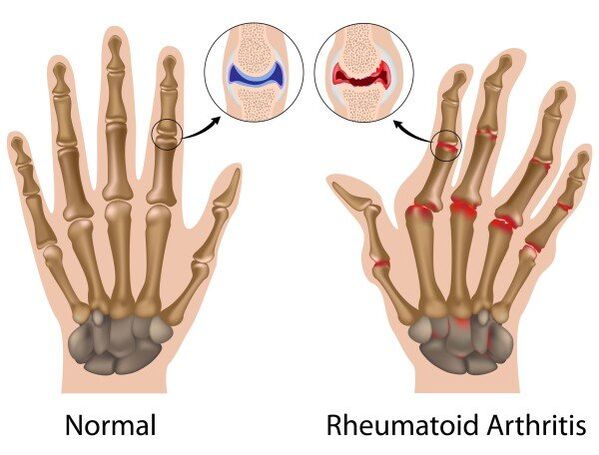 Articolazioni delle dita senza patologia e con artrite reumatoide