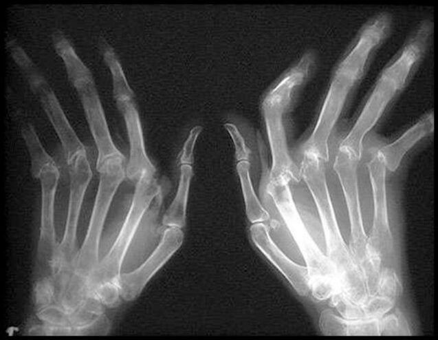Immagine raggi X delle mani colpite dall'osteoartrite
