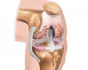 la fase iniziale dell'osteoartrosi del ginocchio