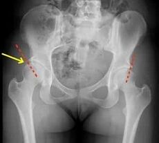 Metodi per il trattamento dell'osteoartrosi dell'articolazione dell'anca