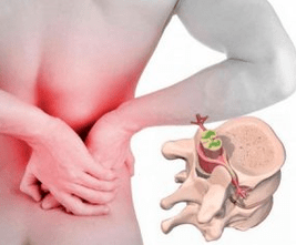 Lumbago all'inizio della malattia osteocondosi