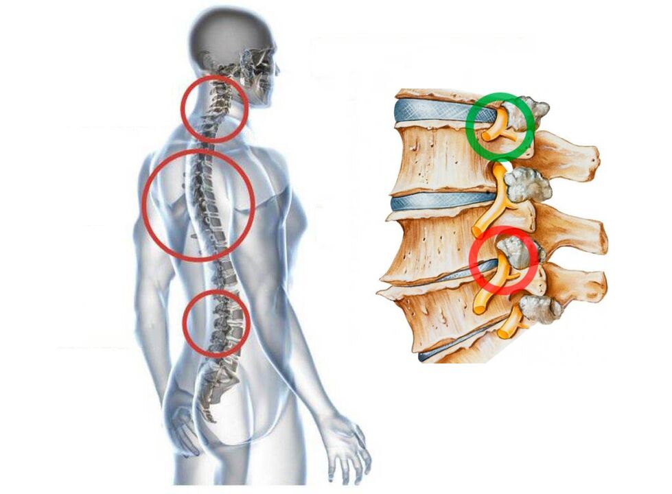 Che aspetto ha l'osteocondosi cervicale come le vertebre