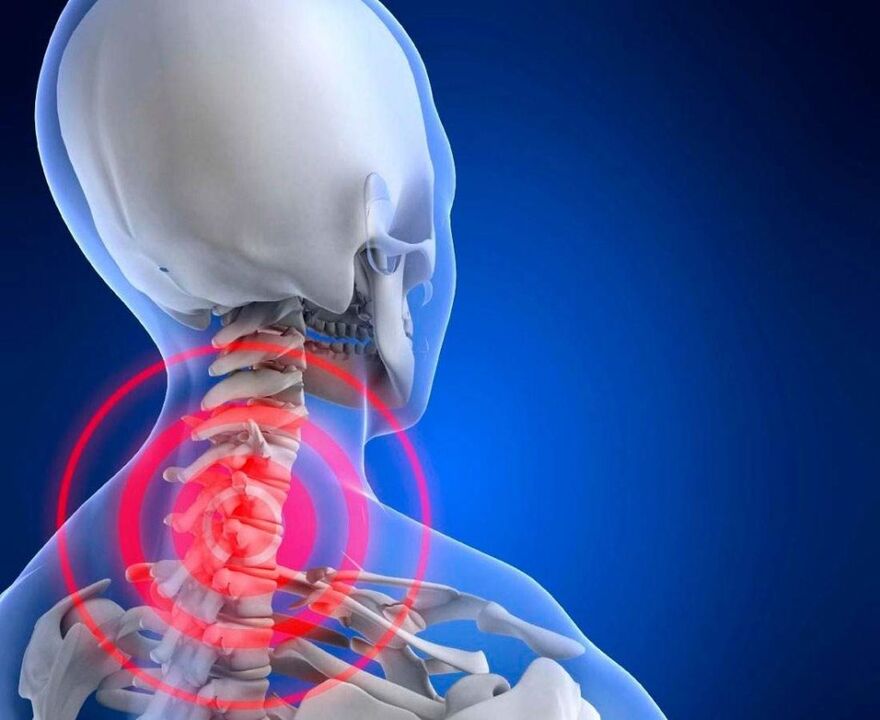Dolore al collo con osteocondosi cervicale