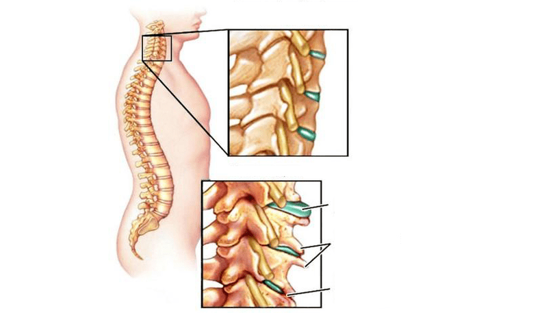 Sindromi di osteocondrosi