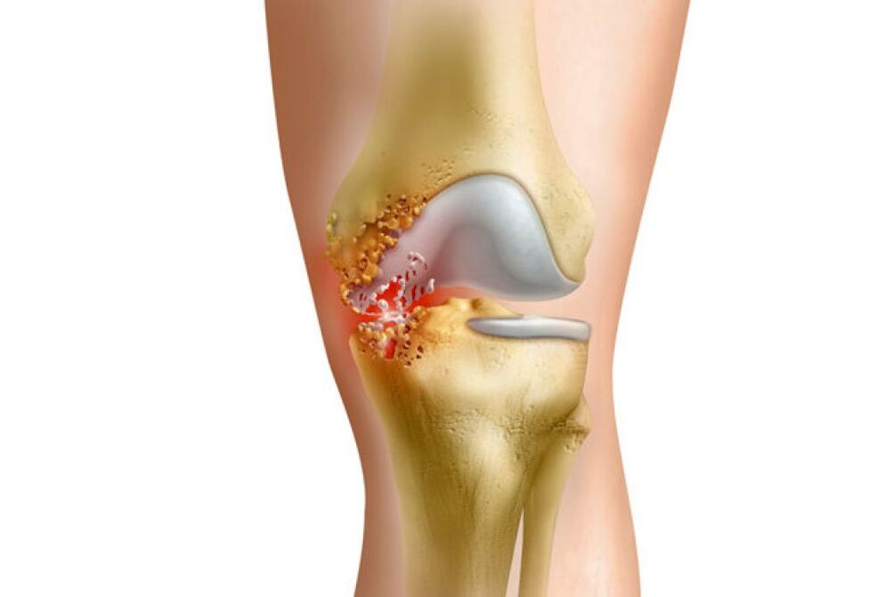 Infiammazione come causa di dolore all'articolazione dell'anca