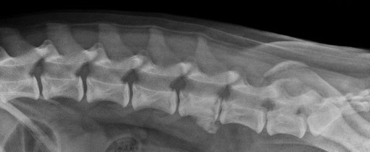 Manifestazioni di osteocondrosi della colonna vertebrale toracica alla radiografia