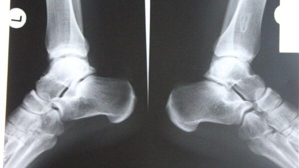 Diagnosi dell'artrosi della caviglia mediante radiografie