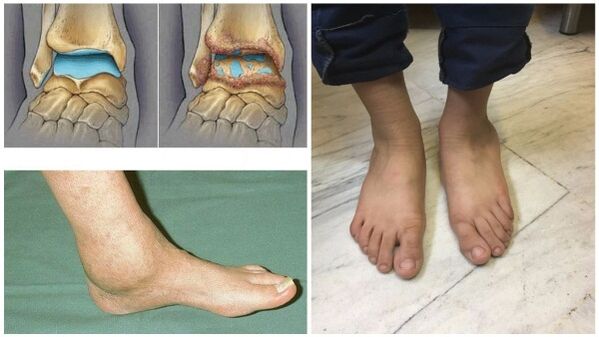 Gonfiore e deformazione dell'articolazione della caviglia dovuti all'osteoartrosi