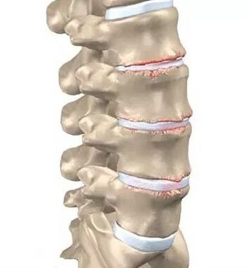 Osteocondrosi