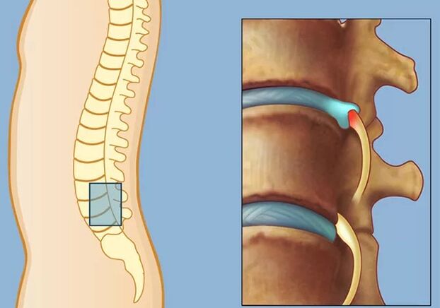 Sindrome di Rook